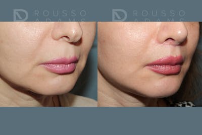 Lip Augmentation <span class=small>By Dr. Austin Adams</span> Before & After Gallery - Patient 185726 - Image 2