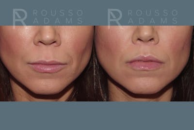Lip Augmentation <span class=small>By Dr. Austin Adams</span> Before & After Gallery - Patient 331753 - Image 1