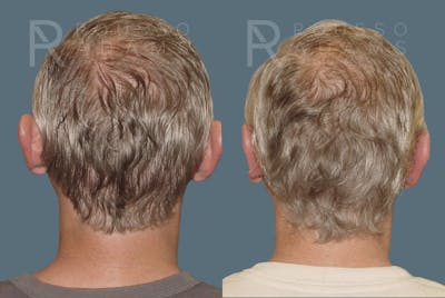 Otoplasty <span class=small>By Dr. Austin Adams</span> Before & After Gallery - Patient 547129 - Image 2