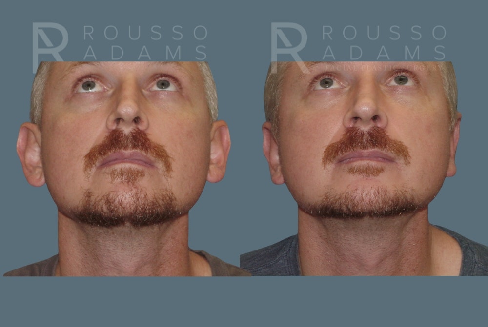 Otoplasty <span class=small>By Dr. Austin Adams</span> Before & After Gallery - Patient 547129 - Image 3