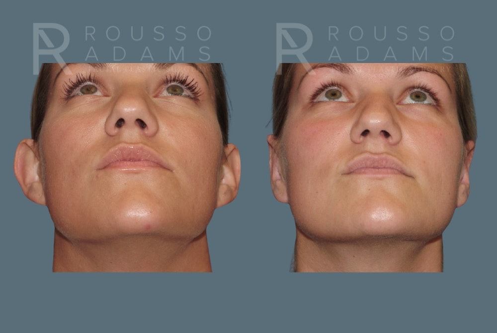 Otoplasty <span class=small>By Dr. Austin Adams</span> Before & After Gallery - Patient 412701 - Image 3