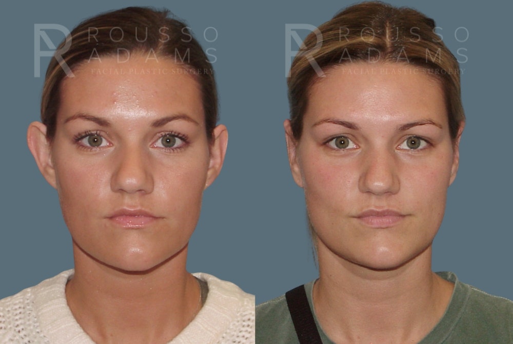 Otoplasty <span class=small>By Dr. Austin Adams</span> Before & After Gallery - Patient 412701 - Image 1