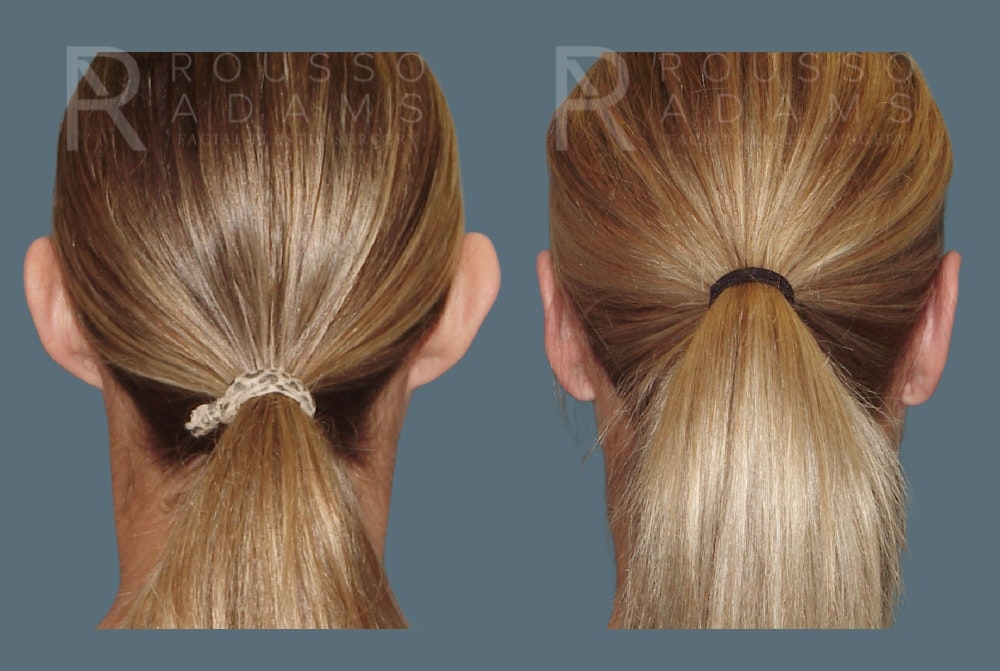 Otoplasty <span class=small>By Dr. Austin Adams</span> Before & After Gallery - Patient 412701 - Image 2