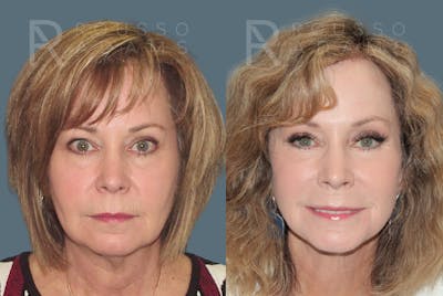 SculptLift™ <span class=small>By Dr. Daniel Rousso</span> Before & After Gallery - Patient 249180 - Image 1