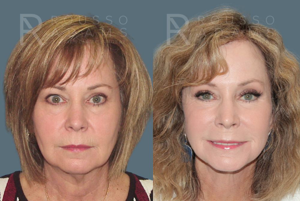 SculptLift™ <span class=small>By Dr. Daniel Rousso</span> Before & After Gallery - Patient 249180 - Image 1