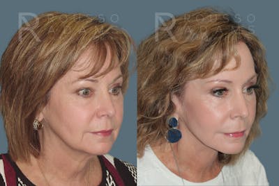 SculptLift™ <span class=small>By Dr. Daniel Rousso</span> Before & After Gallery - Patient 249180 - Image 2