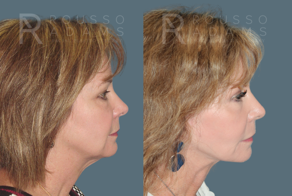 SculptLift™ <span class=small>By Dr. Daniel Rousso</span> Before & After Gallery - Patient 249180 - Image 3