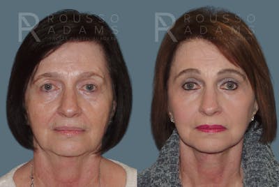 SculptLift™ <span class=small>By Dr. Daniel Rousso</span> Before & After Gallery - Patient 207020 - Image 1