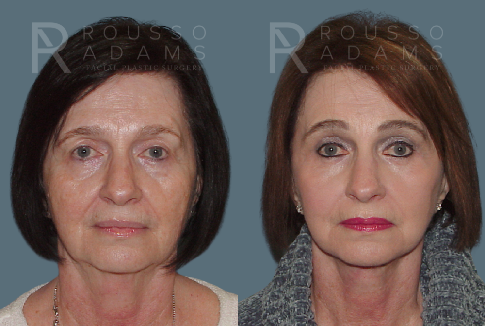 SculptLift™ <span class=small>By Dr. Daniel Rousso</span> Before & After Gallery - Patient 207020 - Image 1