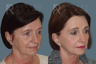 SculptLift™ <span class=small>By Dr. Daniel Rousso</span> Before & After Gallery - Patient 207020 - Image 2