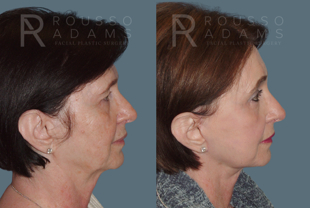 SculptLift™ <span class=small>By Dr. Daniel Rousso</span> Before & After Gallery - Patient 207020 - Image 3