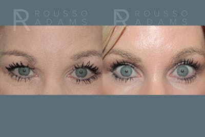 SculptLift™ <span class=small>By Dr. Daniel Rousso</span> Before & After Gallery - Patient 330093 - Image 4