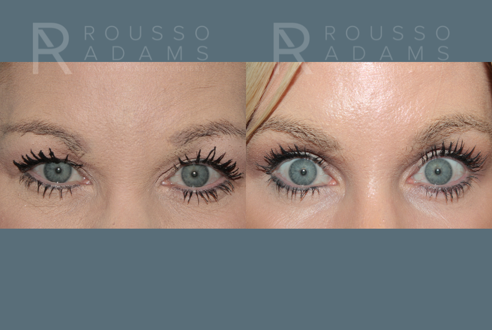 SculptLift™ <span class=small>By Dr. Daniel Rousso</span> Before & After Gallery - Patient 330093 - Image 4
