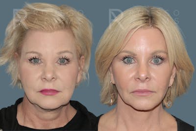 SculptLift™ <span class=small>By Dr. Daniel Rousso</span> Before & After Gallery - Patient 330093 - Image 1