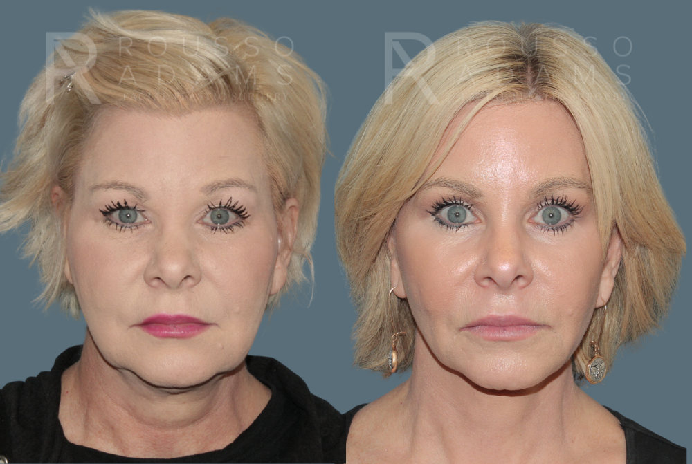 SculptLift™ <span class=small>By Dr. Daniel Rousso</span> Before & After Gallery - Patient 330093 - Image 1