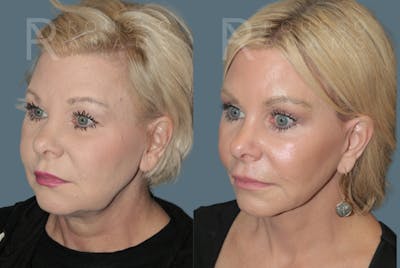 SculptLift™ <span class=small>By Dr. Daniel Rousso</span> Before & After Gallery - Patient 330093 - Image 2
