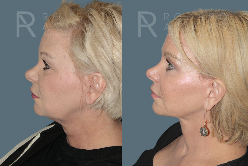 SculptLift™ <span class=small>By Dr. Daniel Rousso</span> Before & After Gallery - Patient 330093 - Image 3