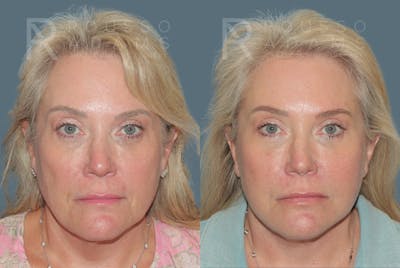 SculptLift™ <span class=small>By Dr. Daniel Rousso</span> Before & After Gallery - Patient 349721 - Image 1