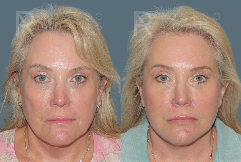 SculptLift™ <span class=small>By Dr. Daniel Rousso</span> Before & After Gallery - Patient 349721 - Image 1