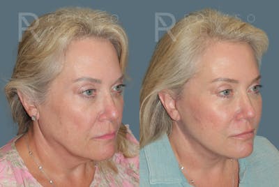 SculptLift™ <span class=small>By Dr. Daniel Rousso</span> Before & After Gallery - Patient 349721 - Image 2