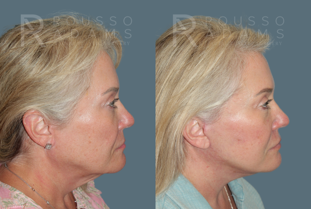 SculptLift™ <span class=small>By Dr. Daniel Rousso</span> Before & After Gallery - Patient 349721 - Image 3