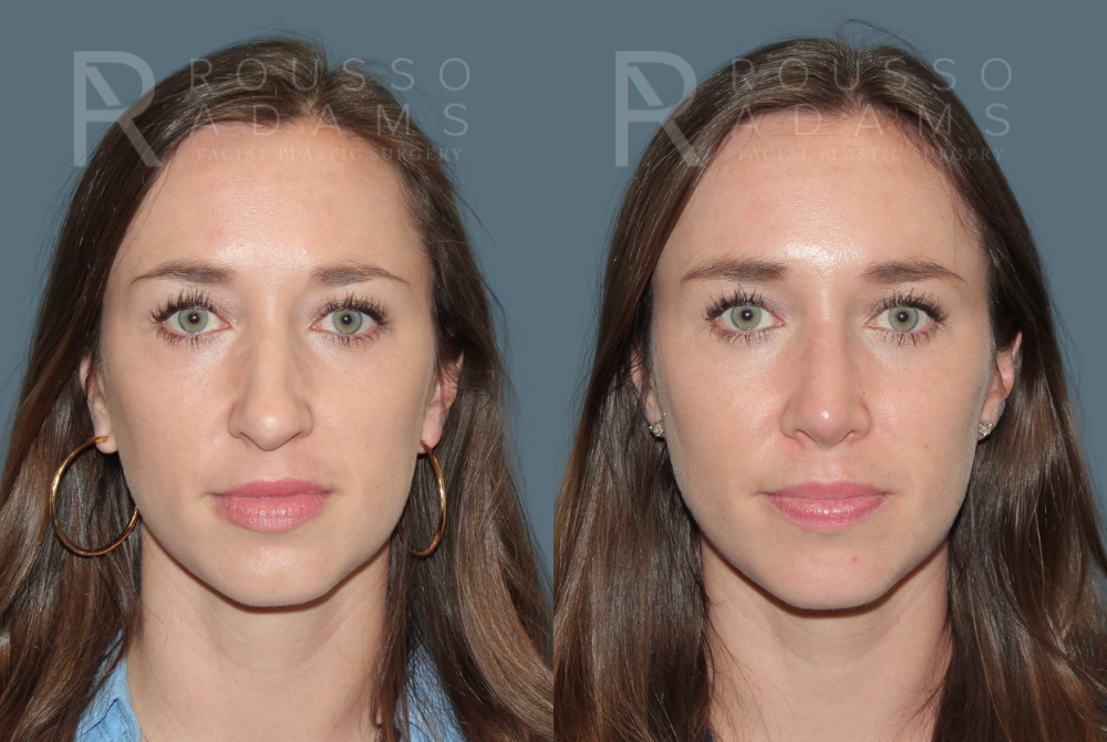 Rhinoplasty <span class=small>By Dr. Daniel Rousso</span> Before & After Gallery - Patient 270781 - Image 3