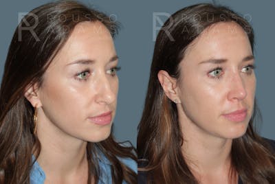Rhinoplasty <span class=small>By Dr. Daniel Rousso</span> Before & After Gallery - Patient 270781 - Image 2