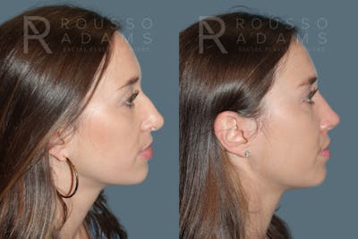 Rhinoplasty <span class=small>By Dr. Daniel Rousso</span> Before & After Gallery - Patient 270781 - Image 1