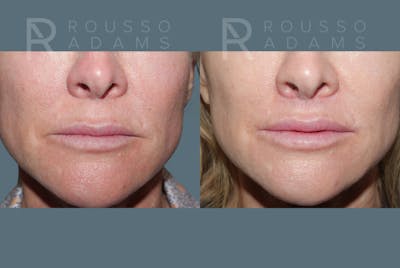 Lip Augmentation <span class=small>By Dr. Austin Adams</span> Before & After Gallery - Patient 117365 - Image 1
