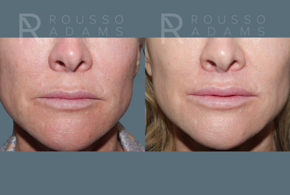 Lip Augmentation <span class=small>By Dr. Austin Adams</span> Before & After Gallery - Patient 117365 - Image 1