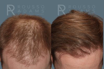 Hair Transplant Before & After Gallery - Patient 488554 - Image 1