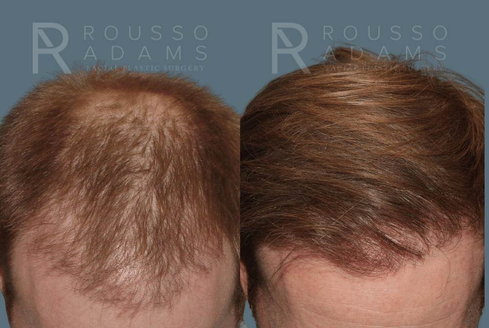 Hair Transplant Before & After Gallery - Patient 488554 - Image 1