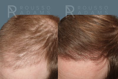 Hair Transplant Before & After Gallery - Patient 488554 - Image 2