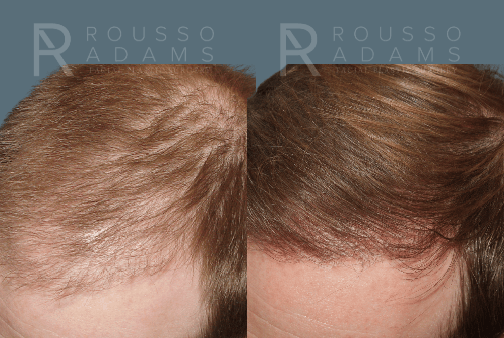 Hair Transplant Before & After Gallery - Patient 488554 - Image 2