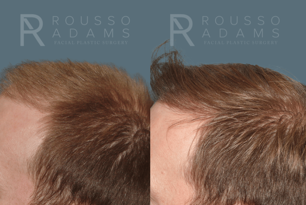 Hair Transplant Before & After Gallery - Patient 488554 - Image 3