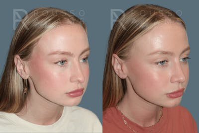 Rhinoplasty<span class=small>By Dr. Austin Adams</span> Before & After Gallery - Patient 150037 - Image 1