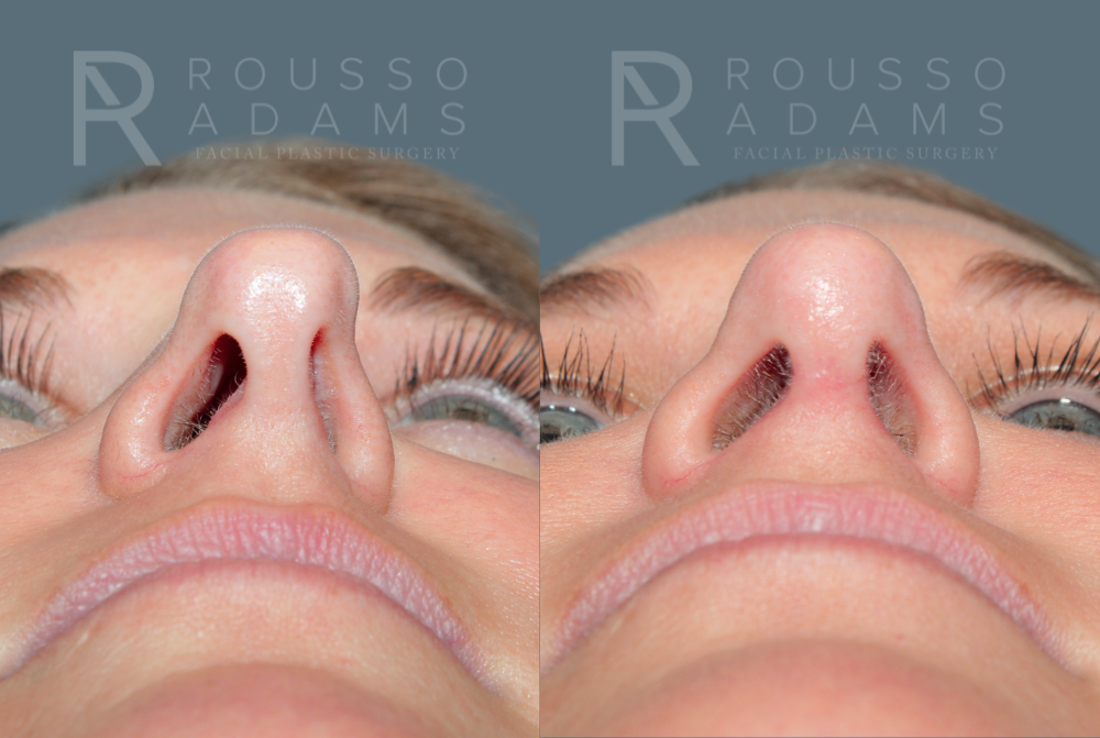 Rhinoplasty<span class=small>By Dr. Austin Adams</span> Before & After Gallery - Patient 181336 - Image 3