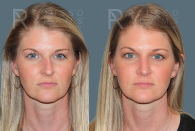Rhinoplasty<span class=small>By Dr. Austin Adams</span> Before & After Gallery - Patient 181336 - Image 2