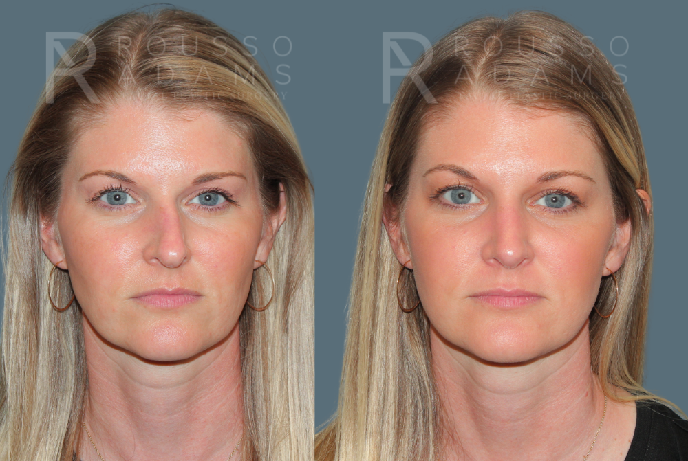 Rhinoplasty<span class=small>By Dr. Austin Adams</span> Before & After Gallery - Patient 181336 - Image 2