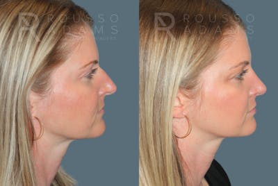 Rhinoplasty<span class=small>By Dr. Austin Adams</span> Before & After Gallery - Patient 181336 - Image 1
