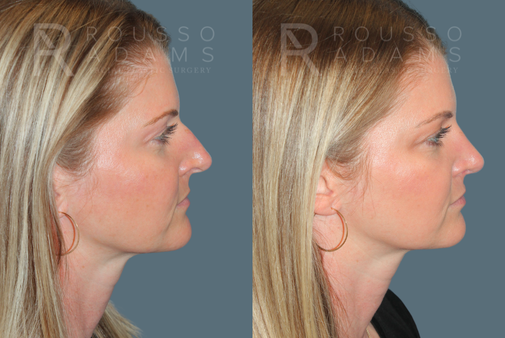 Rhinoplasty<span class=small>By Dr. Austin Adams</span> Before & After Gallery - Patient 181336 - Image 1