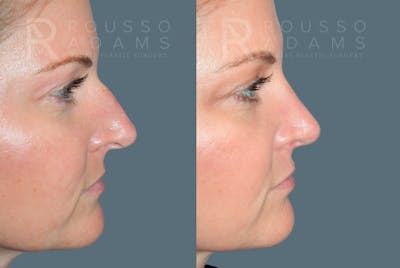 Rhinoplasty<span class=small>By Dr. Austin Adams</span> Before & After Gallery - Patient 181336 - Image 4