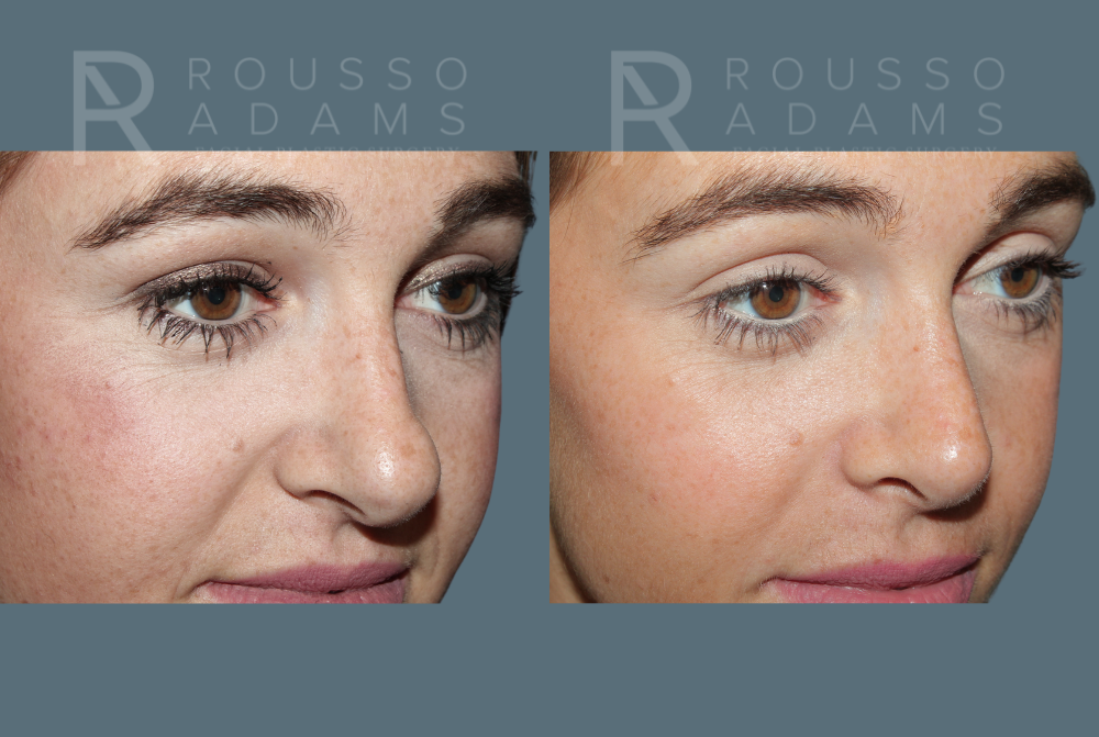 Rhinoplasty <span class=small>By Dr. Daniel Rousso</span> Before & After Gallery - Patient 930393 - Image 5