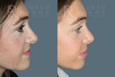 Rhinoplasty <span class=small>By Dr. Daniel Rousso</span> Before & After Gallery - Patient 930393 - Image 4
