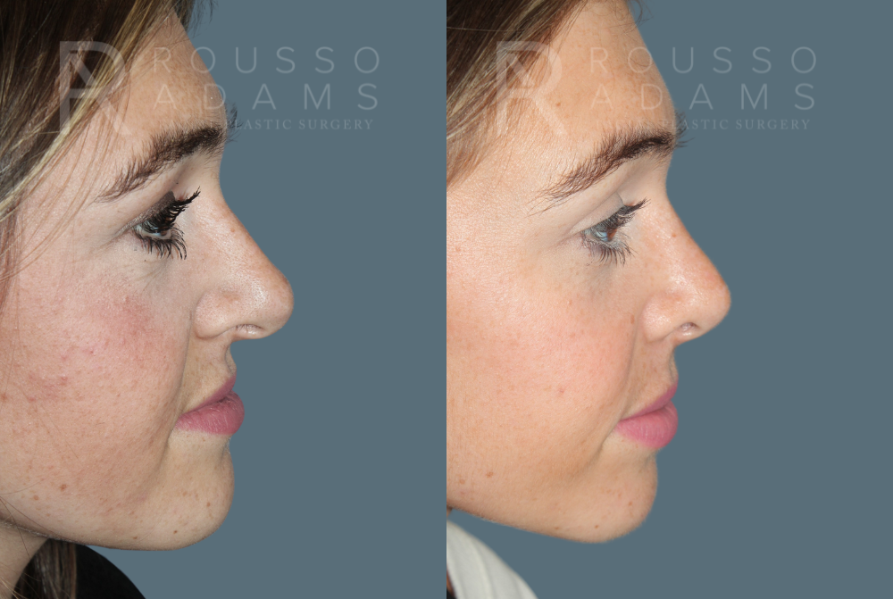 Rhinoplasty <span class=small>By Dr. Daniel Rousso</span> Before & After Gallery - Patient 930393 - Image 4