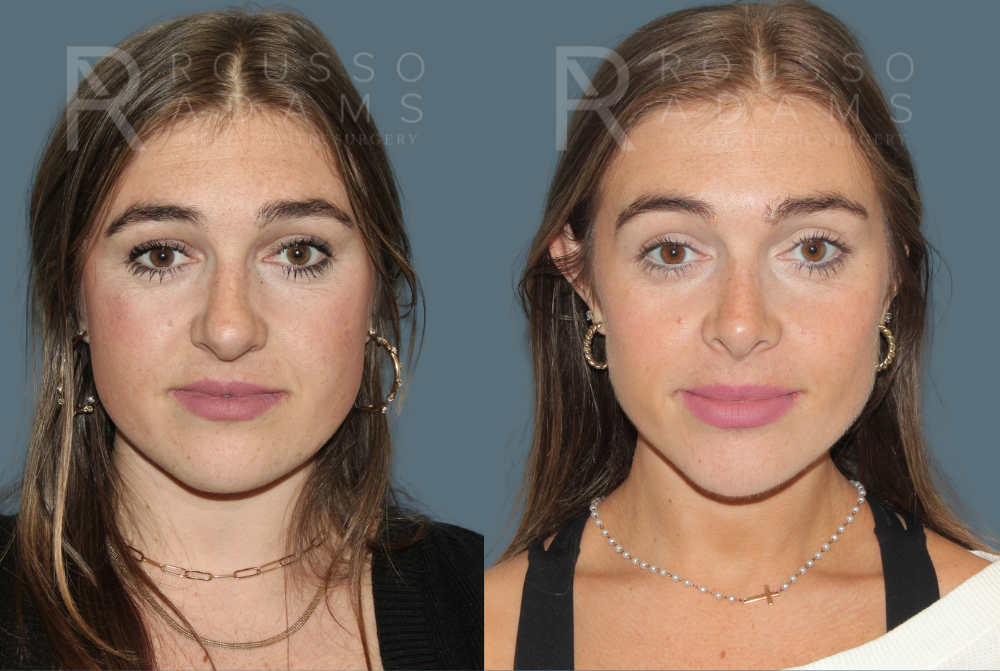 Rhinoplasty <span class=small>By Dr. Daniel Rousso</span> Before & After Gallery - Patient 930393 - Image 3
