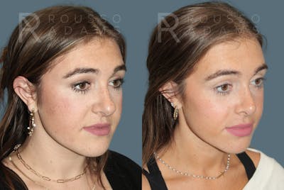 Rhinoplasty <span class=small>By Dr. Daniel Rousso</span> Before & After Gallery - Patient 930393 - Image 2
