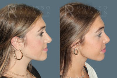 Rhinoplasty <span class=small>By Dr. Daniel Rousso</span> Before & After Gallery - Patient 930393 - Image 1