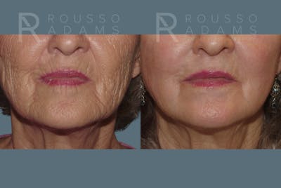 Deep Chemical Peel Gallery <span class=small>By Dr. Daniel Rousso</span> Before & After Gallery - Patient 271518 - Image 4