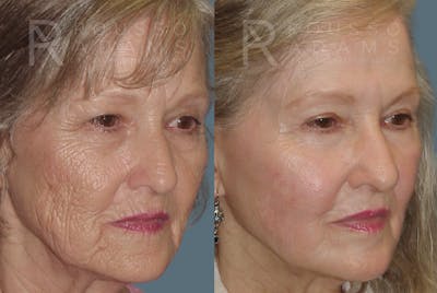 Deep Chemical Peel Gallery <span class=small>By Dr. Daniel Rousso</span> Before & After Gallery - Patient 271518 - Image 1